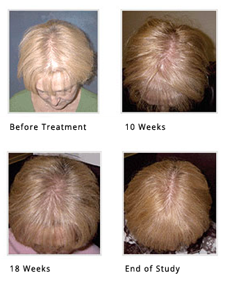 Laser Hair Loss Treatment for Female Hair Loss - Raleigh, North Carolina