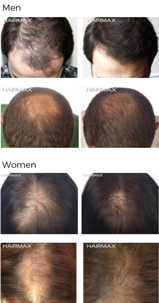 Home Use Laser Hair Therapy Solutions - Jernigan's Hair Transplants Raleigh  North Carolina